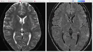 TOP 3 DIFFERENTIALS IN NEURORADIOLOGY [upl. by Laynad]