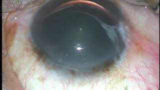 Intravitreal injection of Bevacizumab or Ranibizumab  Pradip Mohanta [upl. by Apollus265]