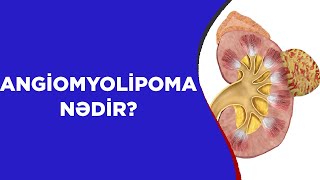 ANGİOMYOLİPOMA NƏDİR❓ [upl. by Aridan345]