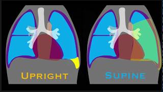 Pleural Effusion Explained by Prometheus Lionhart MD [upl. by Metts]