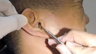 One Hard Earwax Removed form Mans Ear [upl. by Sirapal]