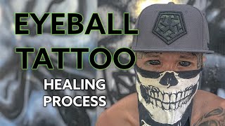 EYEBALL TATTOO HEALING PROCESS I SOLAR BOY [upl. by Corso299]