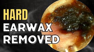 SOLID Hard Earwax Removed After Weeks [upl. by Infeld]