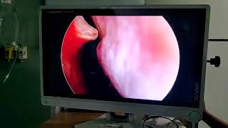 Nasopharyngeal carcinoma  submucosal spread [upl. by Siesser438]