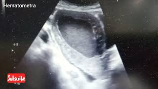 Ultrasound video showing Hematometra [upl. by Roscoe]