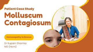 A Case Study of Molluscum Contagiosum [upl. by Jamnis]