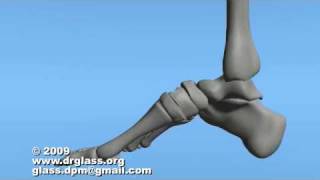 Cole Osteotomy Surgical Procedure of Mid Foot [upl. by Ynnol400]