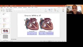 Ventricular Arrhythmias EP Webinar with Dr Verma [upl. by Ailisec]