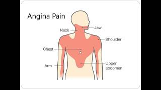 Angina Equivalent Dr Akif Baig [upl. by Asenad]