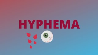 Hyphema  Definition Clinical FeaturesCauseComplicationTreatmentBlack ball 8  Ophthalmology [upl. by Doi]