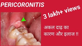 Pericoronitis पेरिकोरोनाइटिस लक्षण कारण और इलाज अकल दाढ़ आने के समय मसूड़ों में सूजन [upl. by Esmond818]