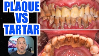 Plaque Vs Tartar  How to Remove Plaque on Teeth amp STOP Dental Calculus [upl. by Ahsyt]