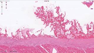 Fibrinous Pericarditis  Histopathology [upl. by Darra120]