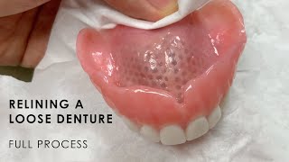 Relining a Loose Denture  Full Process [upl. by Maible]