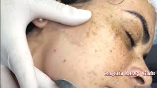 Remove Dead Skin From The Face at Zarpash Beauty Clinic [upl. by Eirrol]