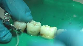 OPERATORIA DENTAL Y ENDODONCIA TÉCNICAS Y MATERIALES5 AMALAGAMA DE PLATA CAVIDAD DE CLASE V [upl. by Aynekat]