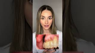 აბფრაქცია dentist teeth defects oralhealth foryou [upl. by Battat]