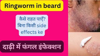 Barbers itch  Fungal infection in beard symptoms and homeopathic treatment [upl. by Vassar]