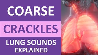 Coarse Crackles Lung Sounds Audio Causes Auscultation Nursing NCLEX Review [upl. by Radloff]