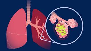 Understanding Pneumococcal Pneumonia [upl. by Gem]