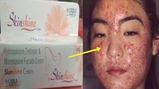 Skin Shine CREAM SIDE EFFECTS के कारण  Reason of SIDE EFFECTS  How to Remove side effects  Hindi [upl. by Alidus]