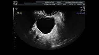 Management of postmenopausal ovarian cyst [upl. by Gilmer]