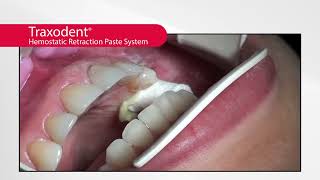 Traxodent® Overview Clinical Case Tooth 12 [upl. by Drwde]