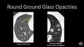 COVID19 CT Findings [upl. by Atter395]