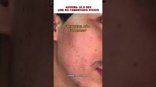 RESULTADO MINOXIDIL SPRAY BARBAS DE MINAS [upl. by Herb]