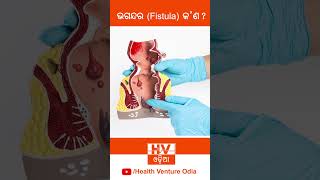 What is Fistula   Dr Biswanath Pattanaik  Reels 1 [upl. by Balbur]