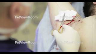 4K Electrocoagulation of papillomas Plastic surgery [upl. by Etta169]