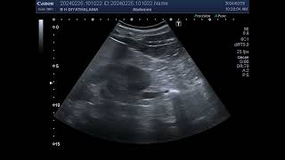 Right hydronephrosis and proximal hydroureter due to a calculus in the midureter [upl. by Runkle]