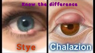 Difference between Stye and Chalazion [upl. by Horn]