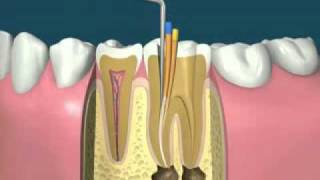 traitement endodontiquedevitalisationflv [upl. by Aitram]