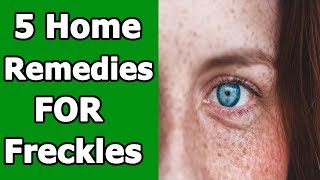 5 Home Remedies To Get Rid of Freckles Fast [upl. by Lyon]