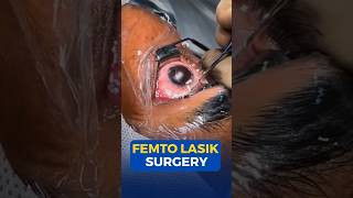 Femto Lasik Surgery [upl. by Aeneg736]