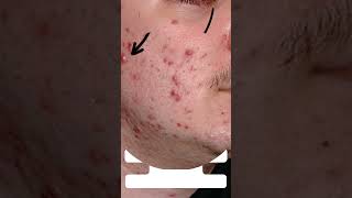 The Ultimate Guide to Treating Papulopustular Acne [upl. by Nwatna121]