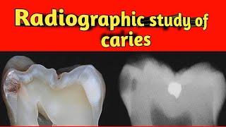 Dental caries and radiograph of caries Type of caries proximal caries  occlusal caries [upl. by Annauqal473]