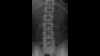 Lumbar Spine Radiology Tutorial [upl. by Tivad810]