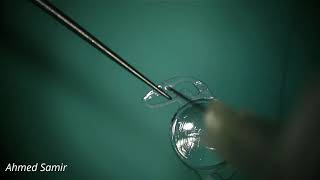 Double flanged prolene suture for scleral fixation of single piece IOLs [upl. by Pierette114]