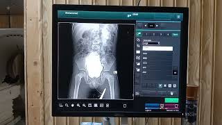 MCUG  micturating cystourethrogram procedure  mcug x ray  easy way to perform mcug x ray [upl. by Irrol997]