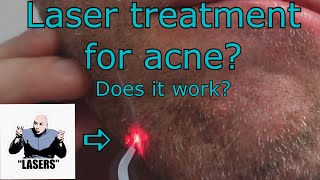 Laser treatment for recurring acne [upl. by Brana]