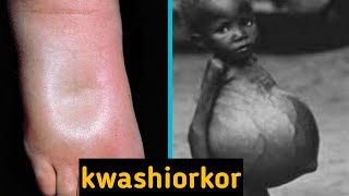 kwashiorkor and its symptoms [upl. by Ahseiym]