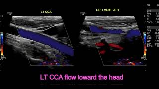 subclavian steal syndrome [upl. by Nhtanhoj]