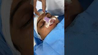 How to add splint after nose rhinoplasty [upl. by Hasheem]