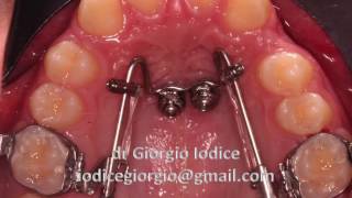 Mesial Slider su ORTHOeasy Forestadent [upl. by Bridgette]