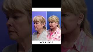 MiniFacelift and Necklift  Avance Plastic Surgery  Dr Erez Dayan  Reno Tahoe NV [upl. by Nwahsram51]