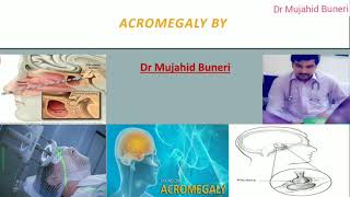 Achieve Mastery In Acromegaly Within 10 Minutes  Dr M B [upl. by Kiefer142]