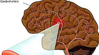 Intracerebral HemorrhageICHEtiology PathophysiologyClinical Features Diagnostic Treatment [upl. by Helyn477]