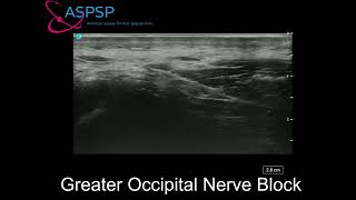 Ultrasound Guided Greater Occipital Nerve Block [upl. by Tija]